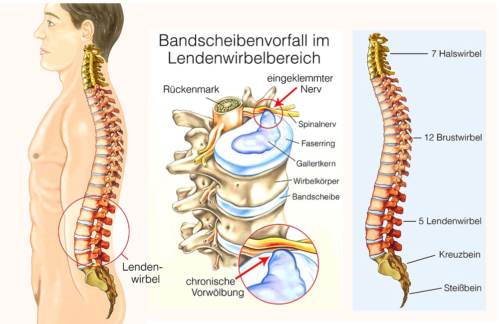 Bandscheiben